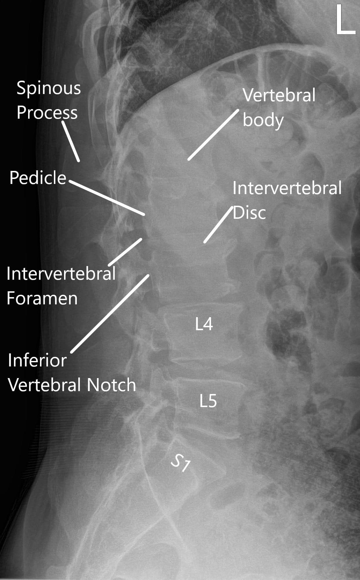Radiografía de la columna vertebral en vistas AP y laterales 2