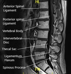 Resonancia magnética de la columna LS en secciones sagital y axial