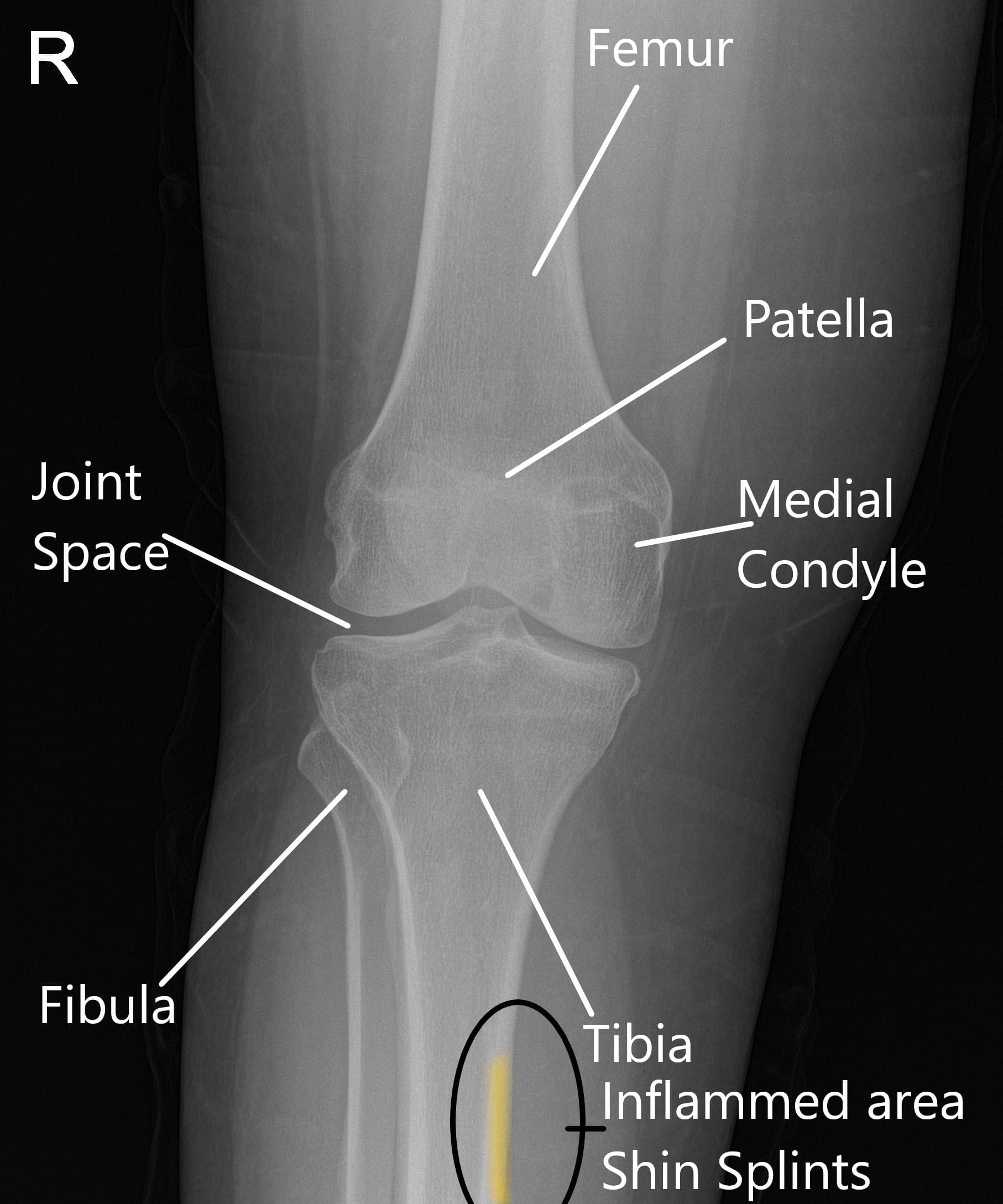 Radiografía de una rodilla normal que muestra la zona inflamada en la periostitis tibial