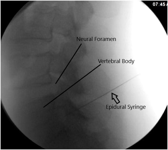 Imágenes de fluoroscopia intraoperatoria Imágenes de fluoroscopia intraoperatoria