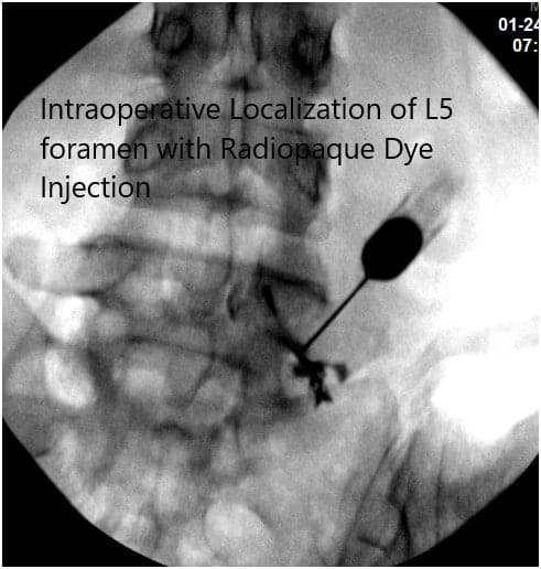 Imágenes de fluoroscopia intraoperatoria 2 Imágenes de fluoroscopia intraoperatoria 2