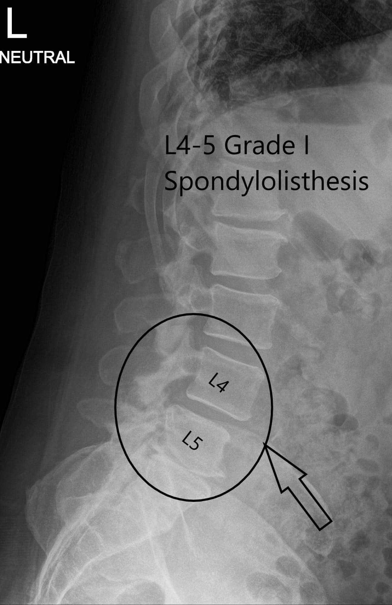 Columna vertebral de la LS con radiografía preoperatoria en visión AP y laterales 2