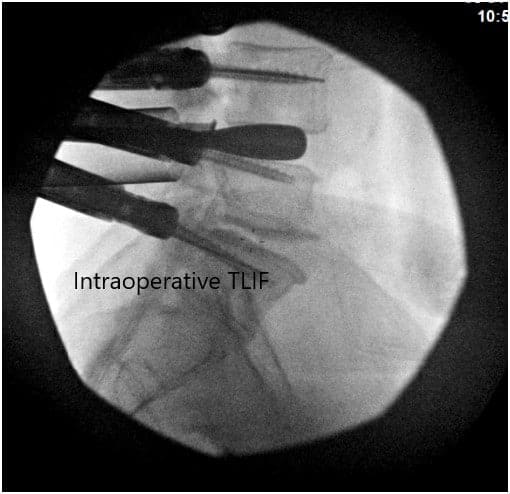 Imágenes fluoroscópicas intraoperatorias 2