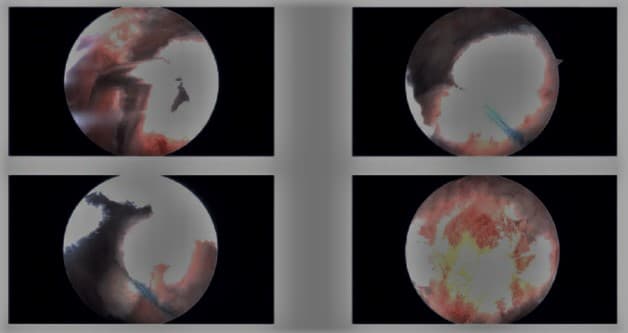 Intraoperative arthroscopic images Intraoperative arthroscopic images