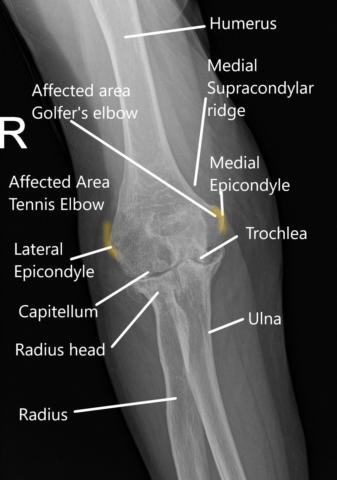 Radiografía de la muñeca que muestra varias partes de la articulación del codo