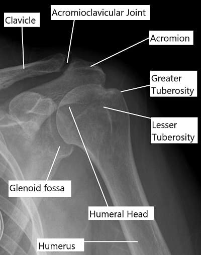 Radiografía de la articulación del hombro.