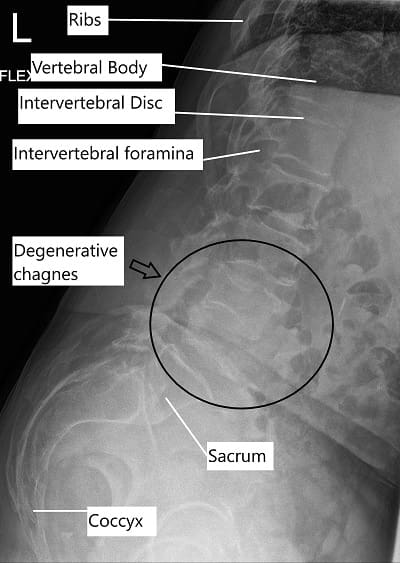Radiografía que muestra enfermedad degenerativa del disco lumbar.