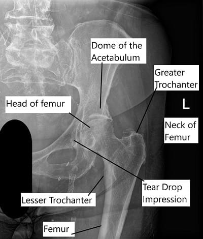 Radiografía que muestra anatomía de cadera.