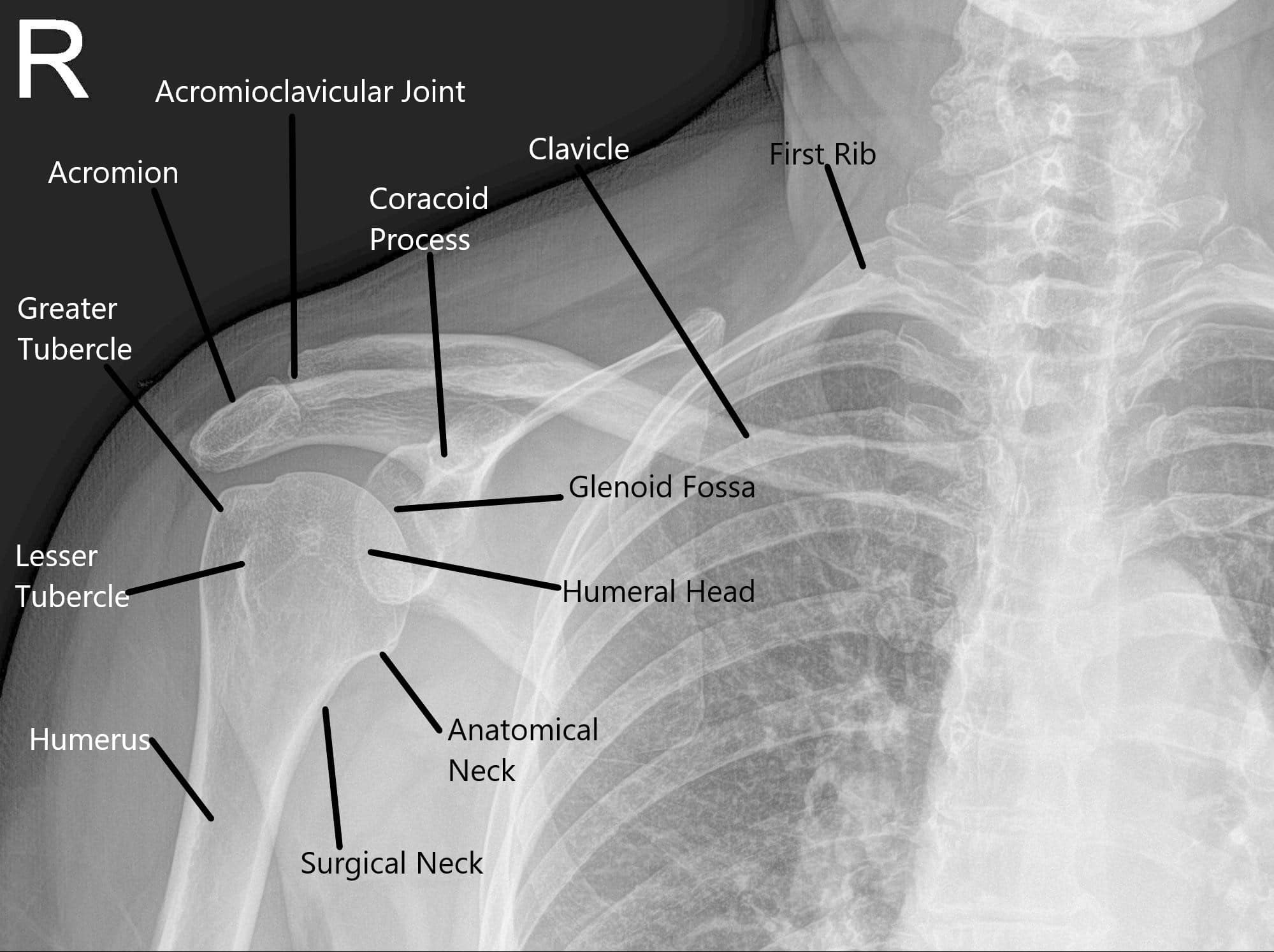 X-ray of the shoulder joint in the AP view