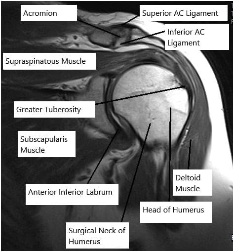 Resonancia magnética de la articulación del hombro