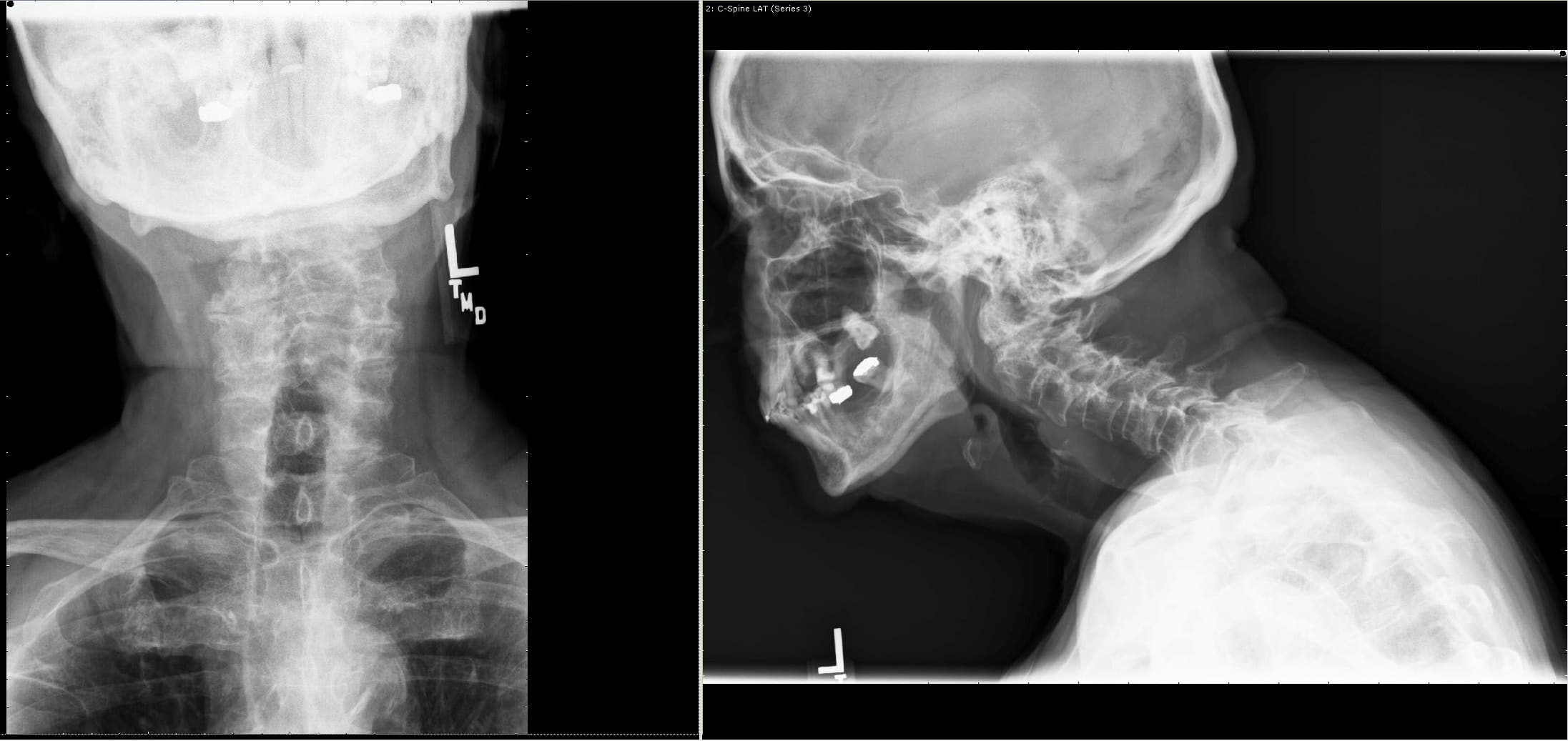 Visión AP y lateral de radiografías que muestran una sospecha de fractura odontoide con inestabilidad en C1-2 Visión AP y lateral de radiografías que muestran una sospecha de fractura odontoide con inestabilidad en C1-2