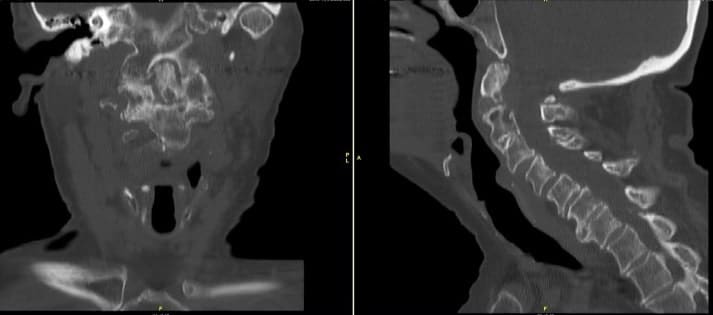 Tomografía computarizada de la columna cervical que muestra la no unión del odontoide junto con cambios degenerativos de la columna cervical Tomografía computarizada de la columna cervical que muestra la no unión del odontoide junto con cambios degenerativos de la columna cervical
