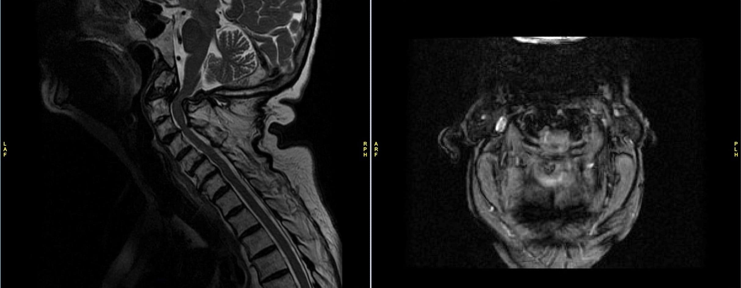 Resonancia magnética de la columna cervical que muestra estenosis crítica en C1-2 con panio fibroso posterior en la fractura odontoide Resonancia magnética de la columna cervical que muestra estenosis crítica en C1-2 con panio fibroso posterior en la fractura odontoide