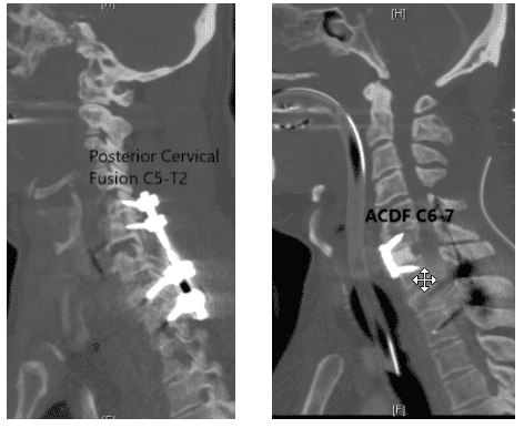 Fusión espinal posterior C5-T2