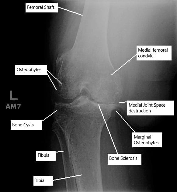 Avanzar la osteoartritis de la articulación de la rodilla izquierda en una radiografía. Avanzar la osteoartritis de la articulación de la rodilla izquierda en una radiografía.