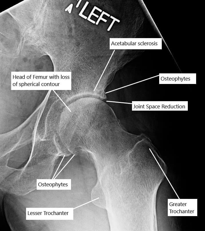 Artrosis de la articulación de la cadera en una radiografía. Artrosis de la articulación de la cadera en una radiografía.