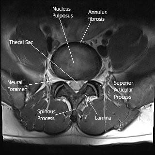 Resonancia magnética de la columna lumbar en la sección axial.