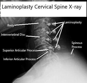 Radiografías AP y de vista lateral de la laminoplastia C3-6