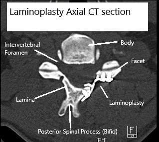 TAC axial Laminoplastia postoperatoria