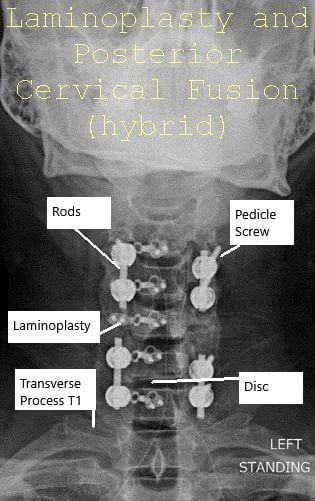 Radiografía con visión panoramática y lateral Laminoplastia postoperatoria y fusión espinal posterior