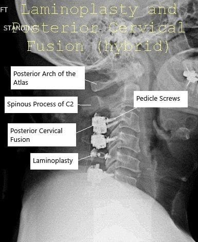 Radiografía con visión panoramática y lateral Laminoplastia postoperatoria y fusión espinal posterior