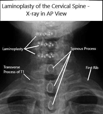 Radiografías AP y de vista lateral de la laminoplastia C3-6