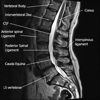 MRI of the lumbar spine showing the interspinous ligament and the spinous process.