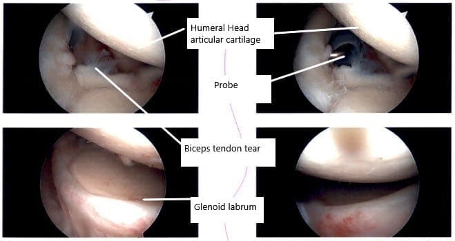 Imágenes artroscópicas intraoperatorias de la articulación del hombro.