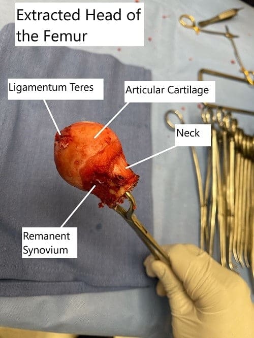 Extracción intraoperatoria de la cabeza del fémur con una sección coronal que muestra la zona necrótica avascular en la cabeza superior medial.