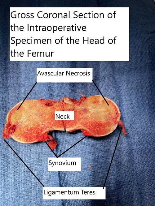 Extracción intraoperatoria de la cabeza del fémur con una sección coronal que muestra la zona necrótica avascular en la cabeza superior medial.