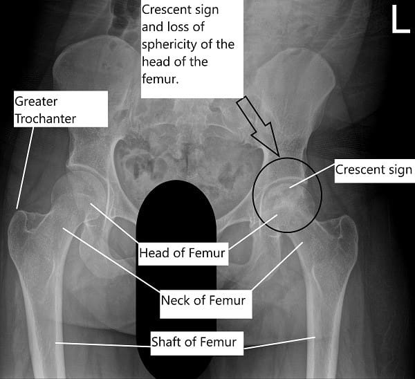 Radiografía de la pelvis con ambas articulaciones de la cadera que muestra un AVN de la cabeza izquierda del fémur.