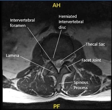 Sección de resonancia axial preoperatoria a nivel L2-L3 que muestra hernia de disco.