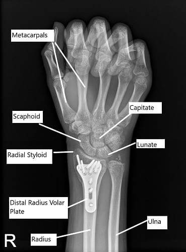 Radiografía postoperatoria de la muñeca derecha en vista de PA.