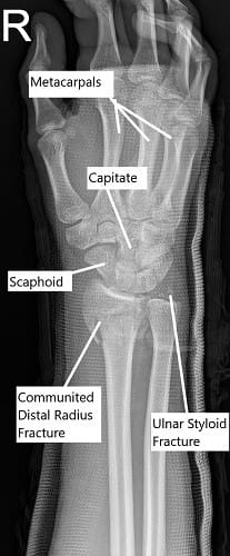 Radiografía de la muñeca en vista oblicua que muestra una fractura conminuta del radio distal.