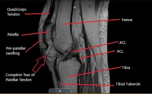MRI of the knee in the sagittal section showing a complete tear of the patellar tendon.