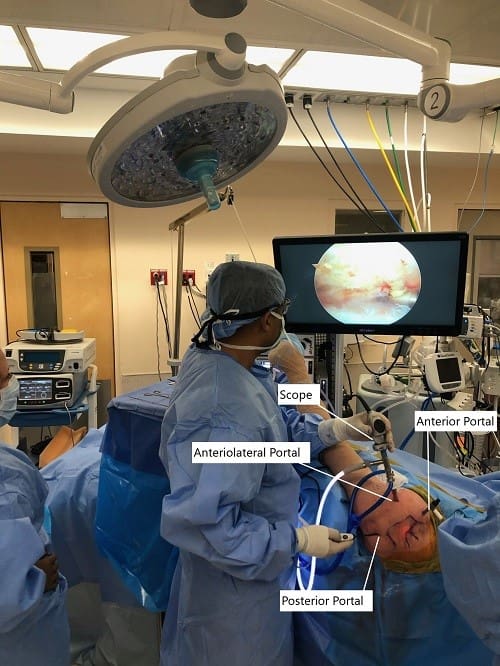 Imagen intraoperatoria de la instalación de la cirugía artroscópica de hombro.