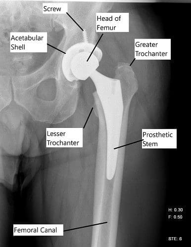 Radiografía que muestra un reemplazo total de cadera.