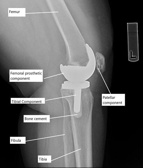 Radiografía que muestra un reemplazo total de rodilla.