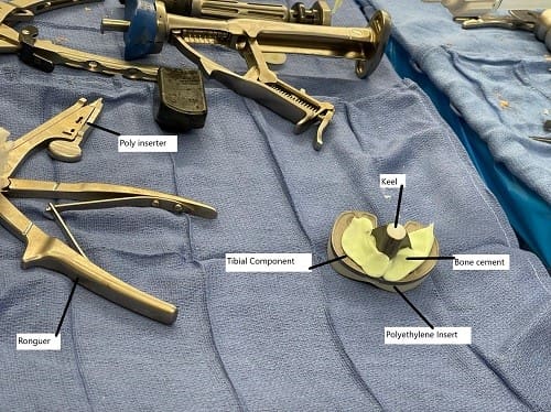 Imagen intraoperatoria que muestra el cementado del componente tibial.