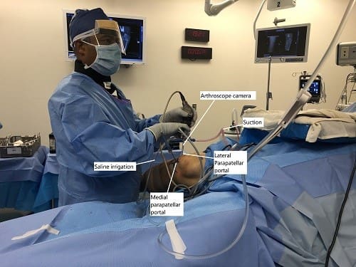 Imagen intraoperatoria que muestra la reparación artroscópica de la MPFL.