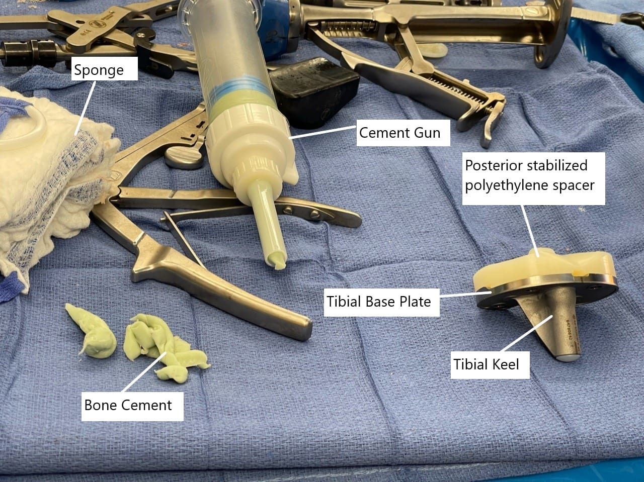 Imagen intraoperatoria que muestra el componente tibial con espaciador de polietileno.