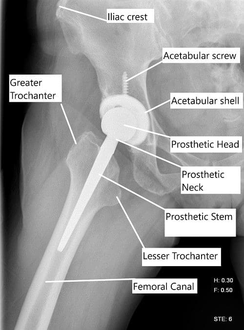 Radiografía que muestra una vista lateral de una prótesis total de cadera.
