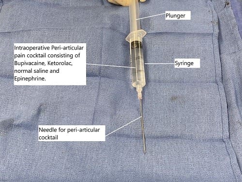 Cóctel intraoperatorio para inyección periarticular utilizado para el control del dolor tras la cirugía.