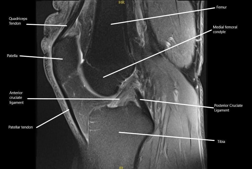 La resonancia magnética muestra los ligamentos cruzados normales en la articulación de la rodilla en la sección sagital.