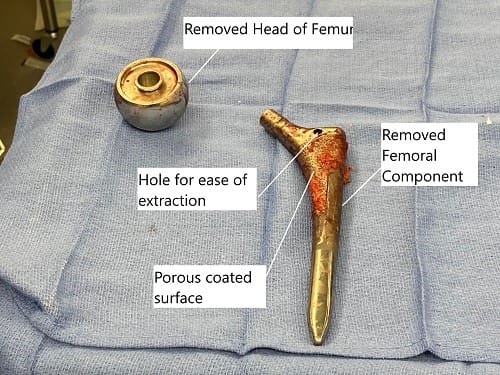 Extracción de la cabeza del fémur y del componente femoral durante la cirugía de revisión.