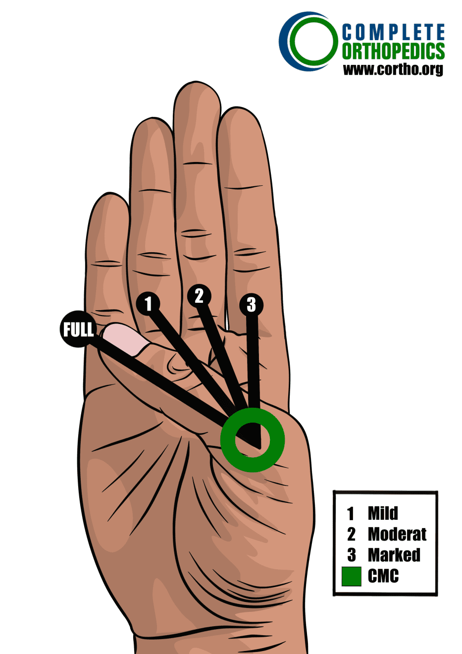 articulación carpometacarpiana del pulgar para evaluar la pérdida de movimiento y calcular la pérdida de uso programada para pacientes de compensación laboral