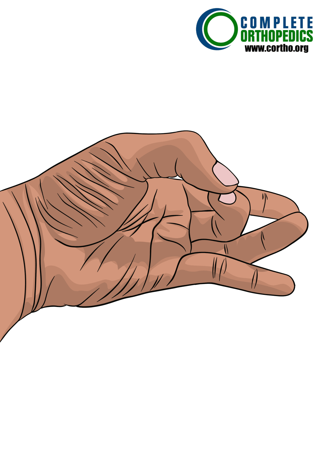 Aislado-Oposición del pulgar para evaluar la pérdida de movimiento y calcular la pérdida de uso programada para un paciente de compensación laboral