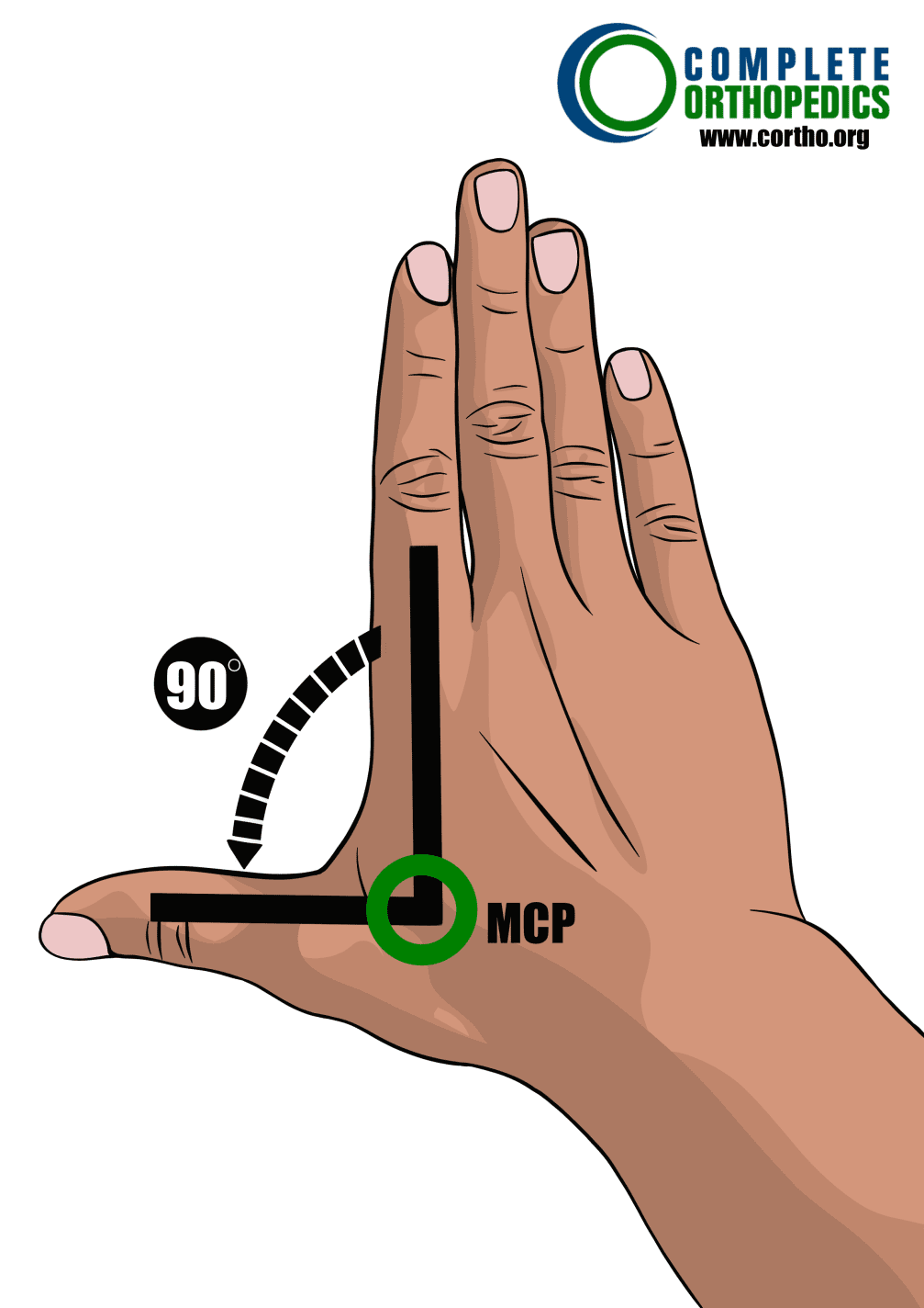 Abducción radial de la articulación metacarpopalángica para evaluar la pérdida de movimiento y calcular la pérdida programada de uso en pacientes de compensación laboral