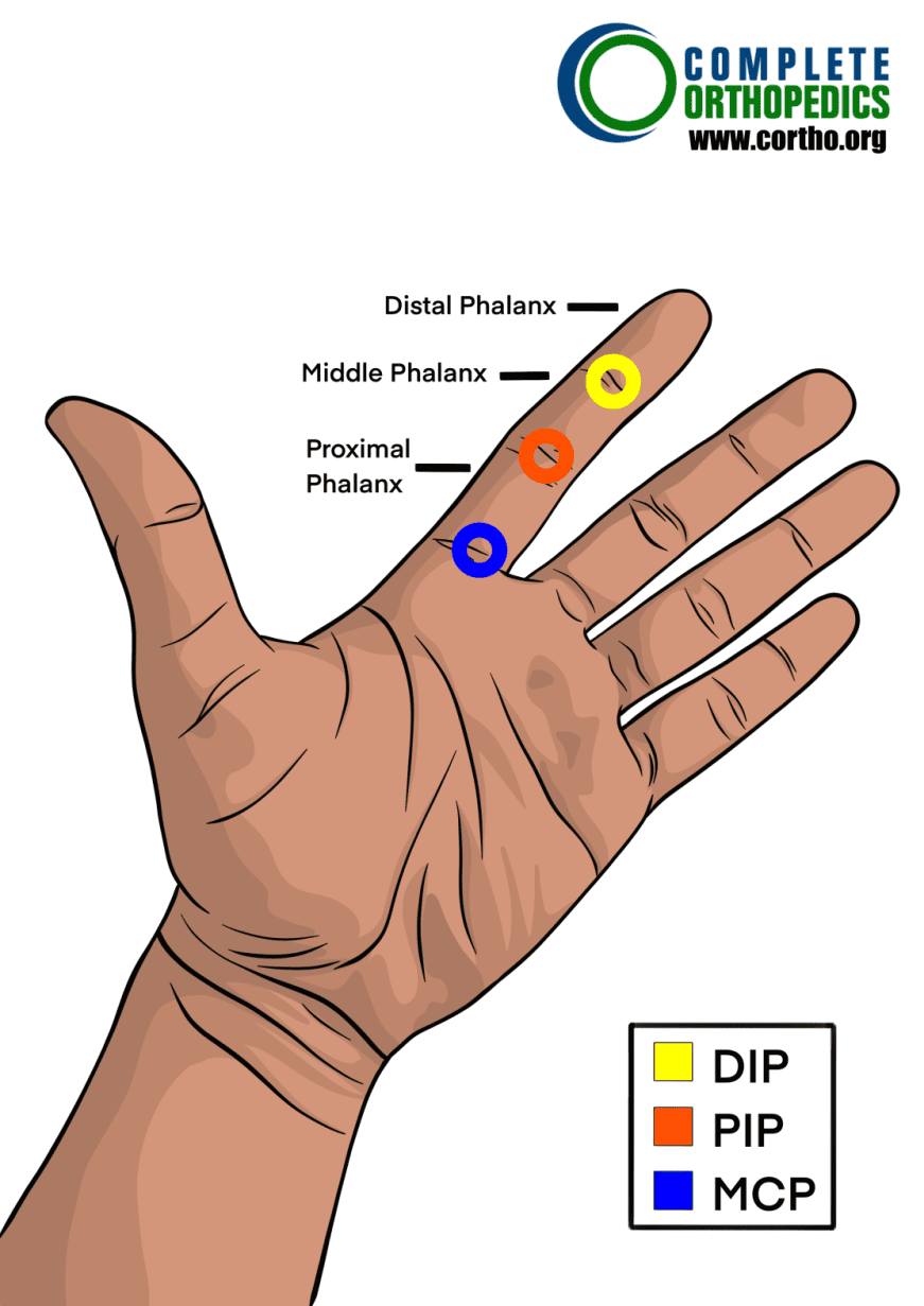 La articulación interfalángica metacarpopalángica, proximal e interfalángica y distal para evaluar la pérdida de movimiento y calcular la pérdida de uso programada para pacientes de compensación laboral