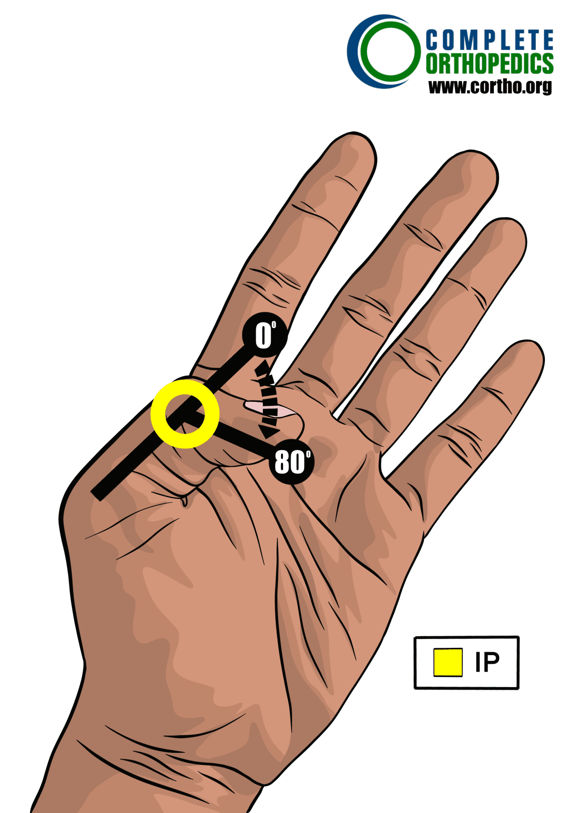 Articulación interfalángica del pulgar para evaluar la pérdida de movimiento y calcular la pérdida de uso programada para pacientes de compensación laboral